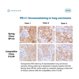 VENTANA PD-L1 (SP142) Assay